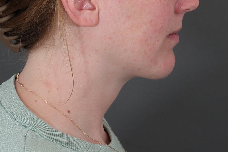 Submental Liposuction Before & After Gallery - Patient 831565 - Image 8