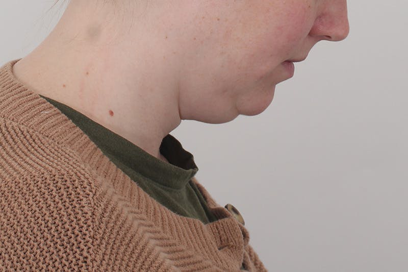 Submental Liposuction Before & After Gallery - Patient 831565 - Image 9