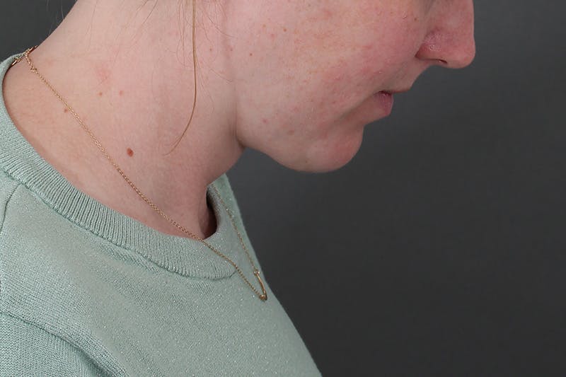 Submental Liposuction Before & After Gallery - Patient 831565 - Image 10