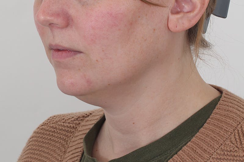 Submental Liposuction Before & After Gallery - Patient 831565 - Image 3