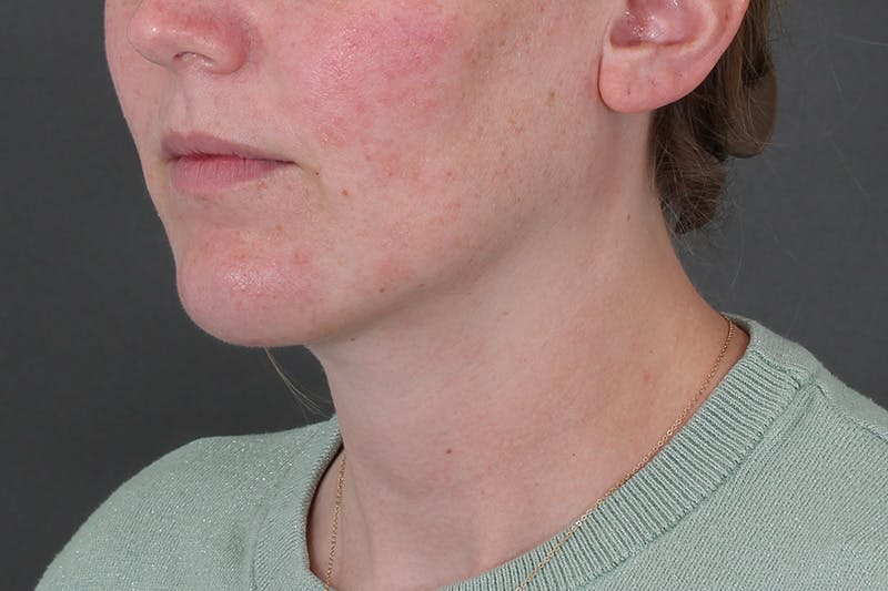 Submental Liposuction Before & After Gallery - Patient 831565 - Image 4