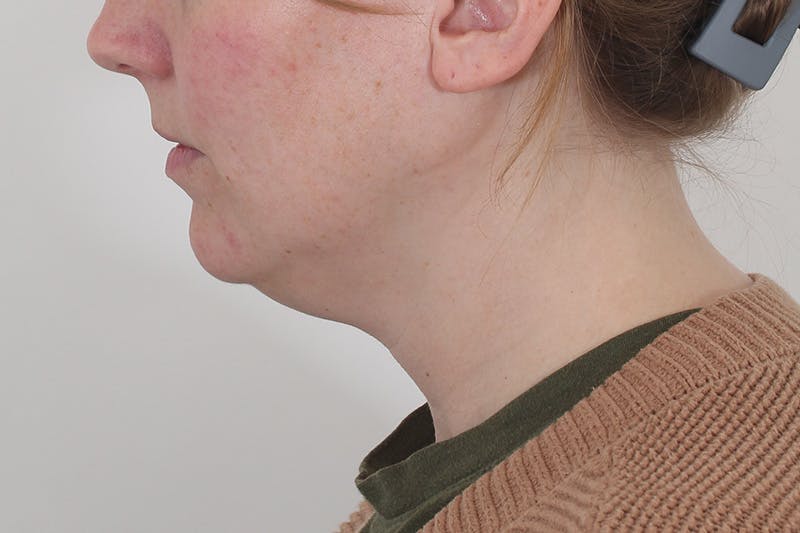 Submental Liposuction Before & After Gallery - Patient 831565 - Image 1