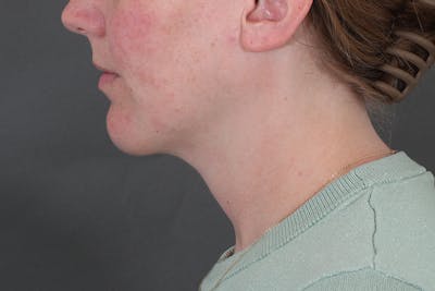 Submental Liposuction Before & After Gallery - Patient 831565 - Image 2