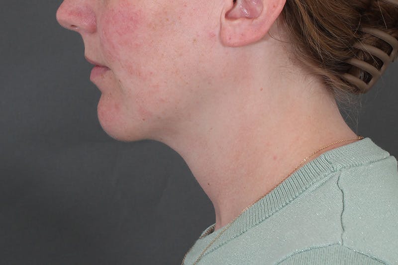 Submental Liposuction Before & After Gallery - Patient 831565 - Image 2