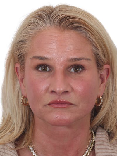 Brow Lift Before & After Gallery - Patient 460766 - Image 2