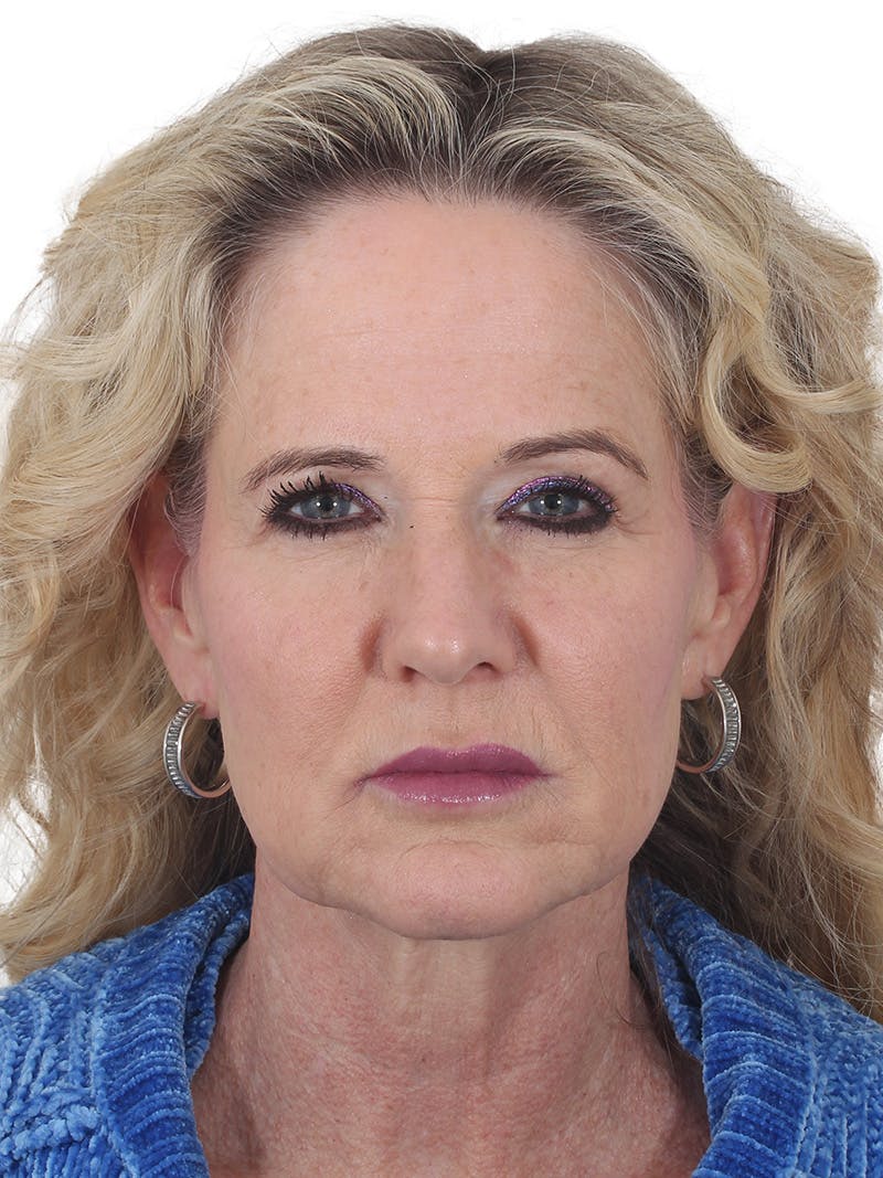 Facelift/Neck Lift Before & After Gallery - Patient 149005 - Image 1