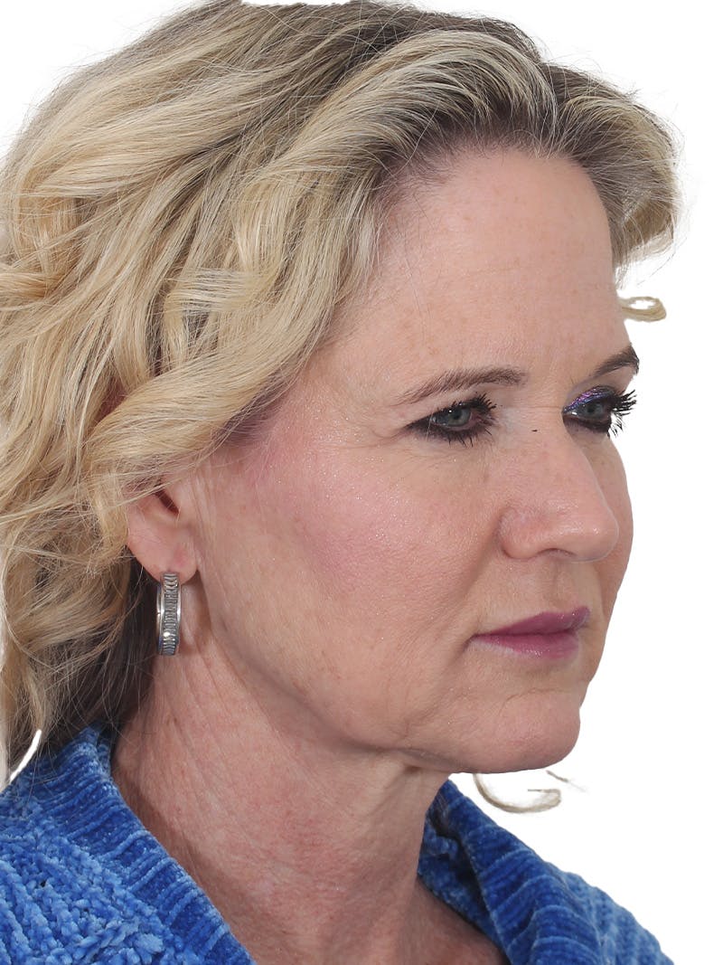 Facelift/Neck Lift Before & After Gallery - Patient 149005 - Image 3