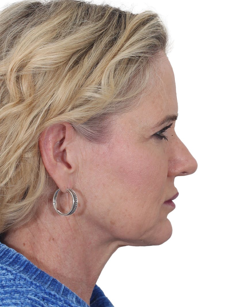 Facelift/Neck Lift Before & After Gallery - Patient 149005 - Image 5