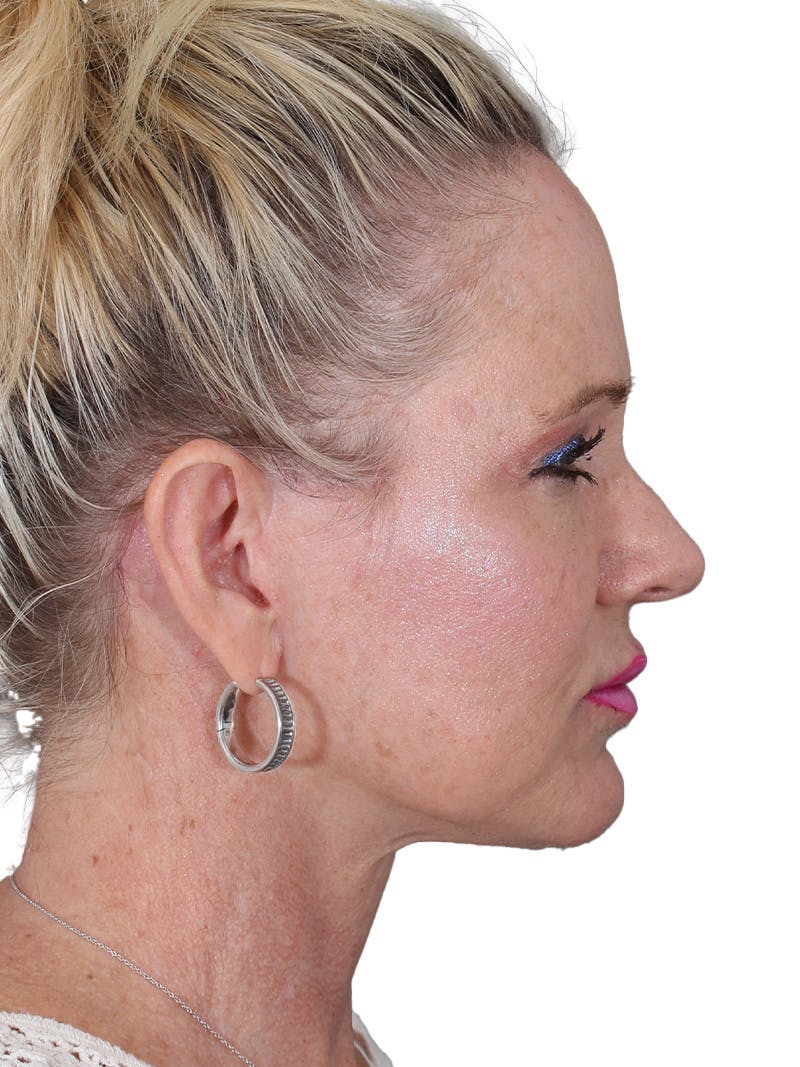 Facelift/Neck Lift Before & After Gallery - Patient 149005 - Image 6