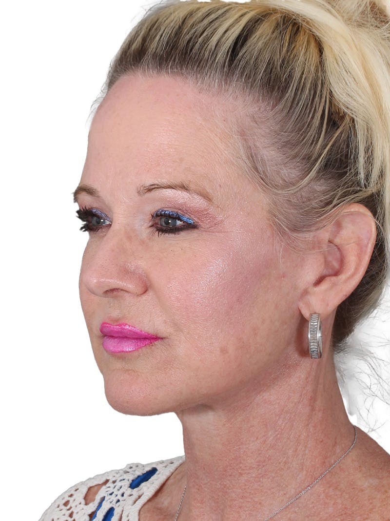 Facelift/Neck Lift Before & After Gallery - Patient 149005 - Image 8