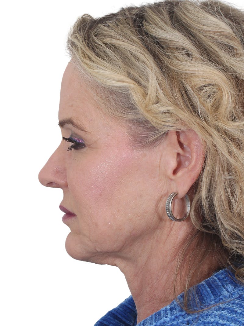Facelift/Neck Lift Before & After Gallery - Patient 149005 - Image 9