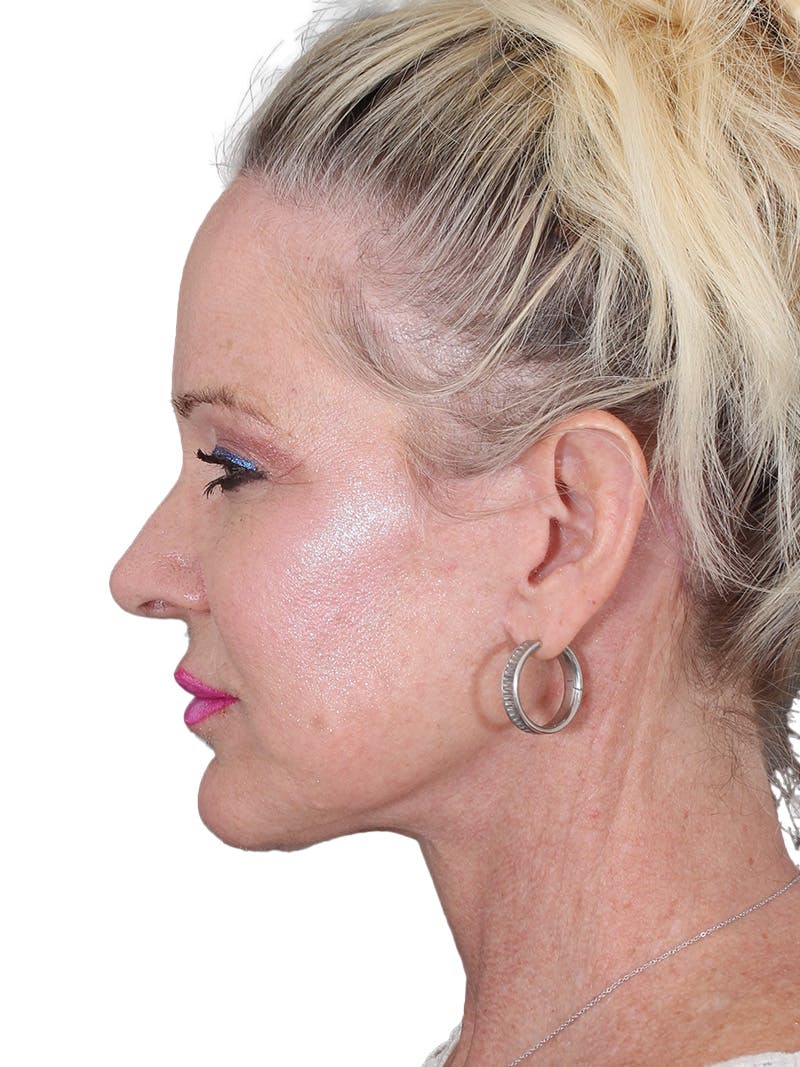 Facelift/Neck Lift Before & After Gallery - Patient 149005 - Image 10