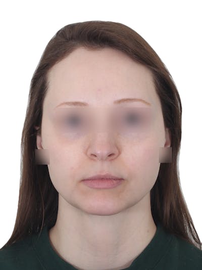 Chin Augmentation Before & After Gallery - Patient 276398 - Image 2