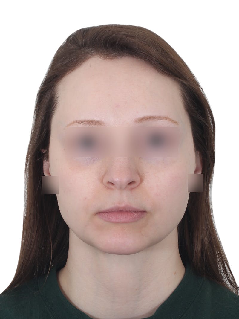 Submental Liposuction Before & After Gallery - Patient 108703 - Image 2