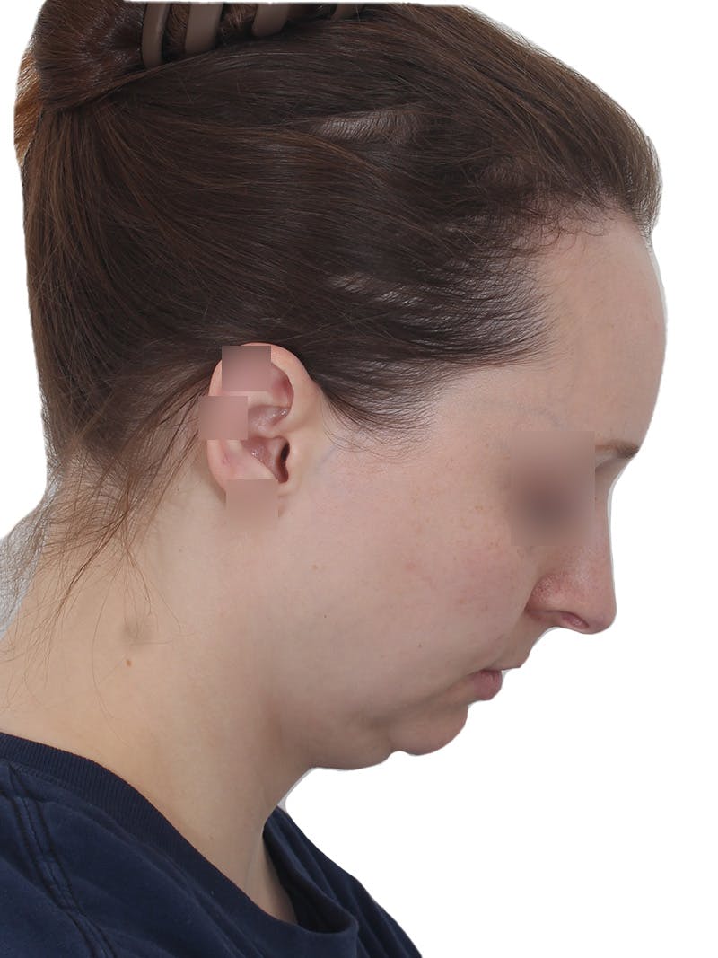 Submental Liposuction Before & After Gallery - Patient 108703 - Image 7