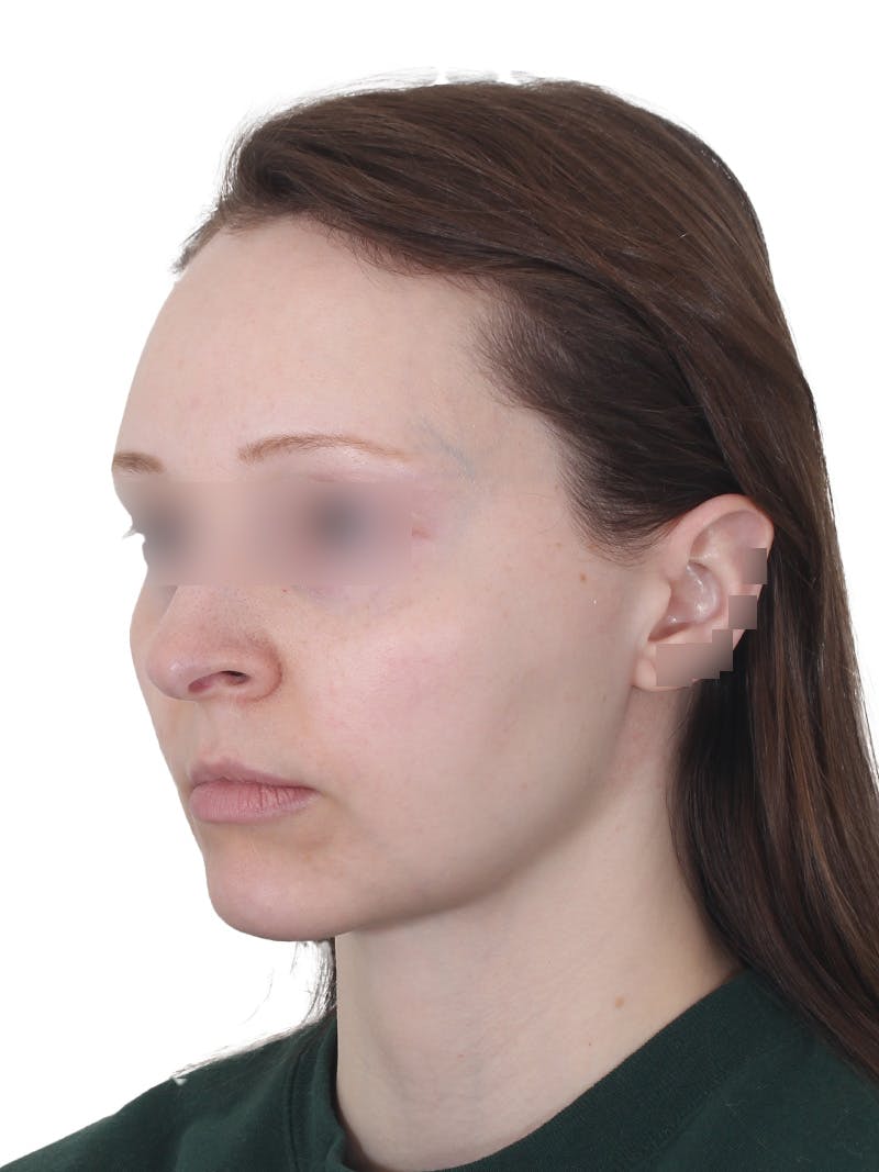 Submental Liposuction Before & After Gallery - Patient 108703 - Image 10