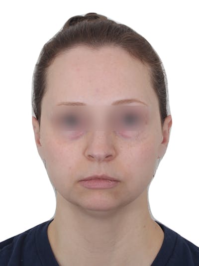 Chin Augmentation Before & After Gallery - Patient 276398 - Image 1