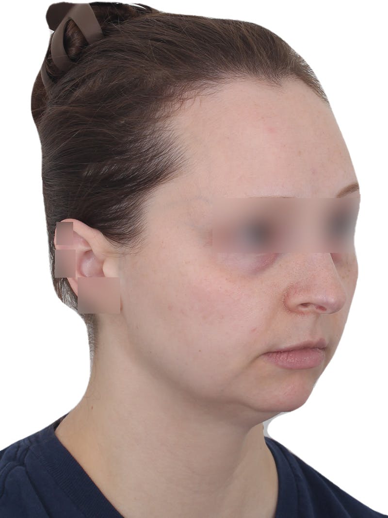 Submental Liposuction Before & After Gallery - Patient 108703 - Image 3