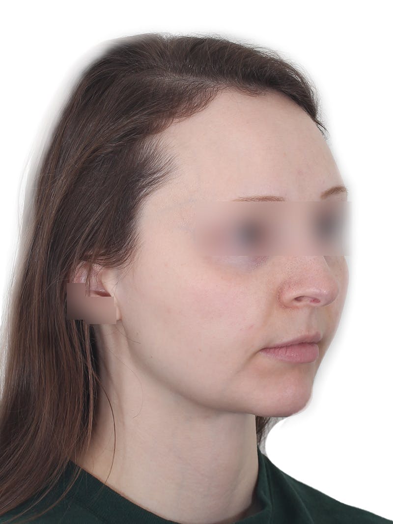Submental Liposuction Before & After Gallery - Patient 108703 - Image 4