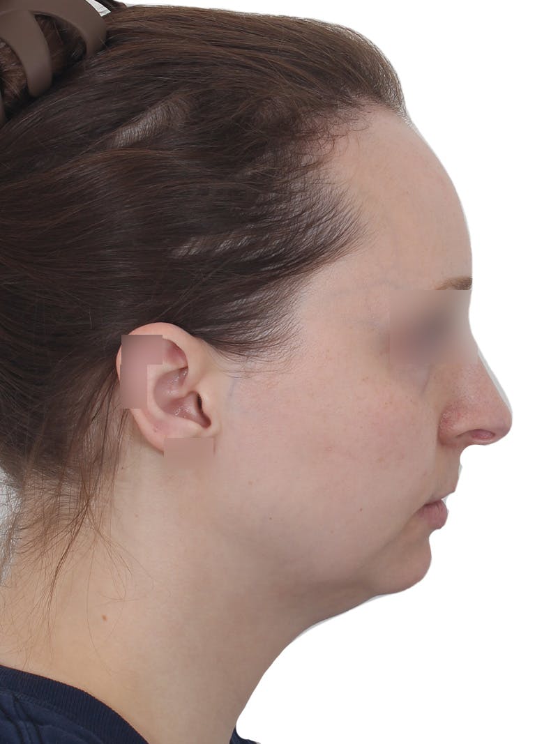 Submental Liposuction Before & After Gallery - Patient 108703 - Image 5