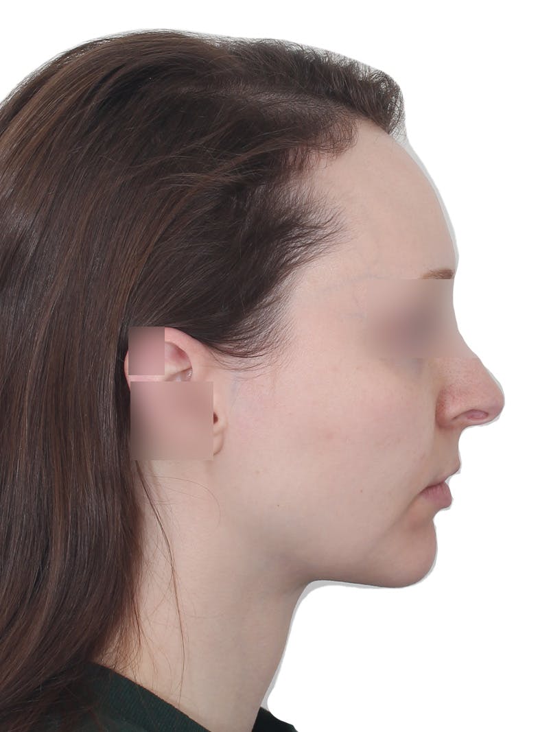 Submental Liposuction Before & After Gallery - Patient 108703 - Image 6