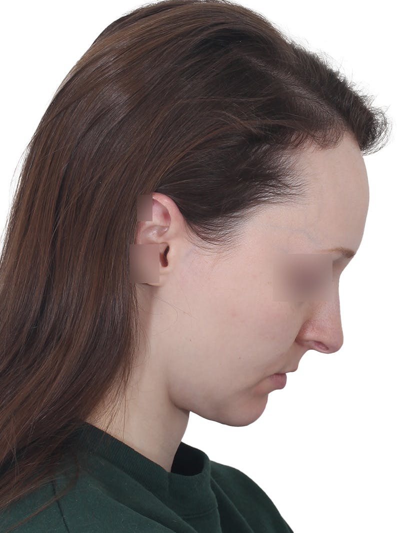 Submental Liposuction Before & After Gallery - Patient 108703 - Image 8