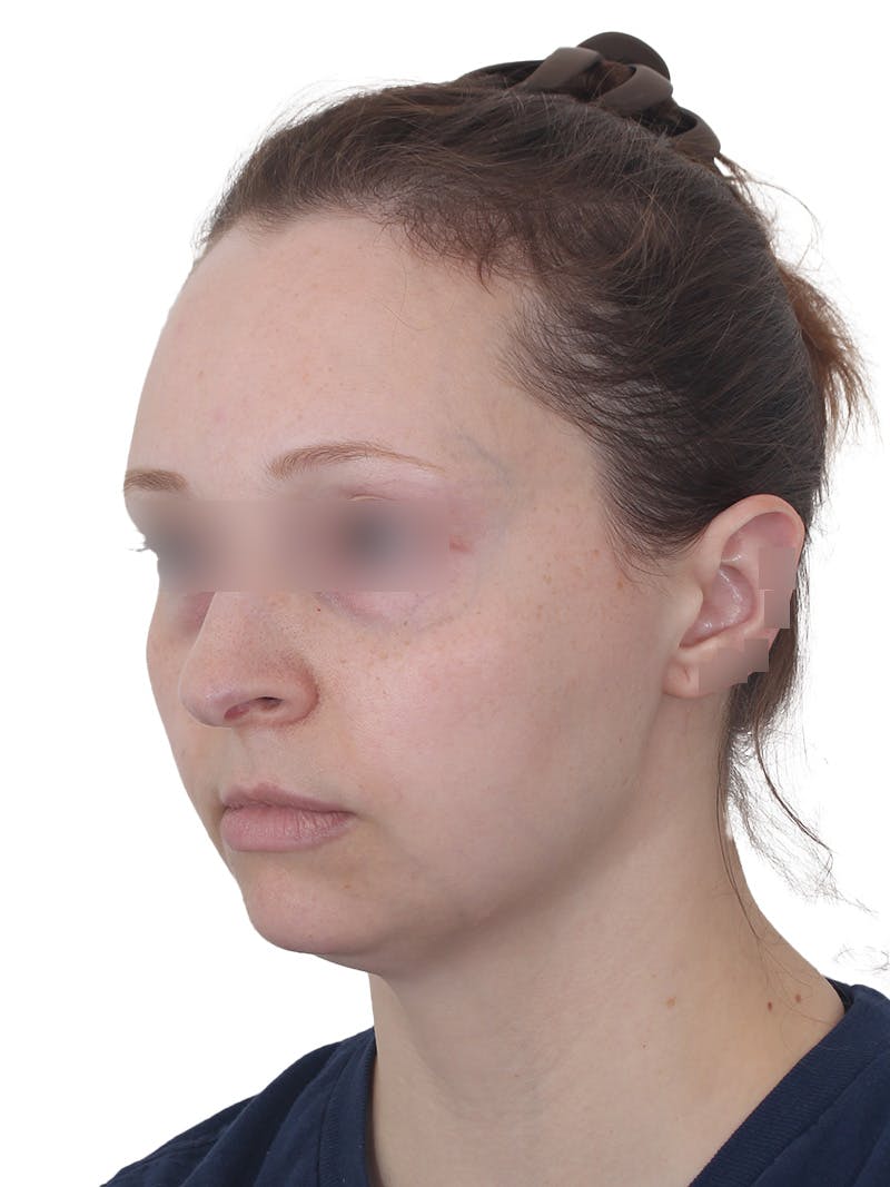 Submental Liposuction Before & After Gallery - Patient 108703 - Image 9