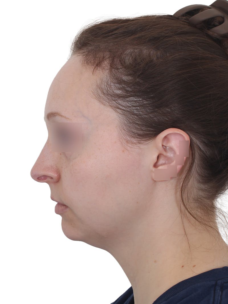 Submental Liposuction Before & After Gallery - Patient 108703 - Image 11