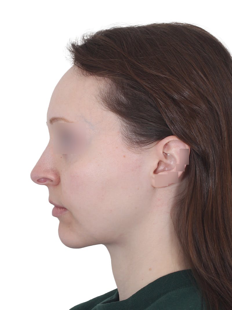 Submental Liposuction Before & After Gallery - Patient 108703 - Image 12