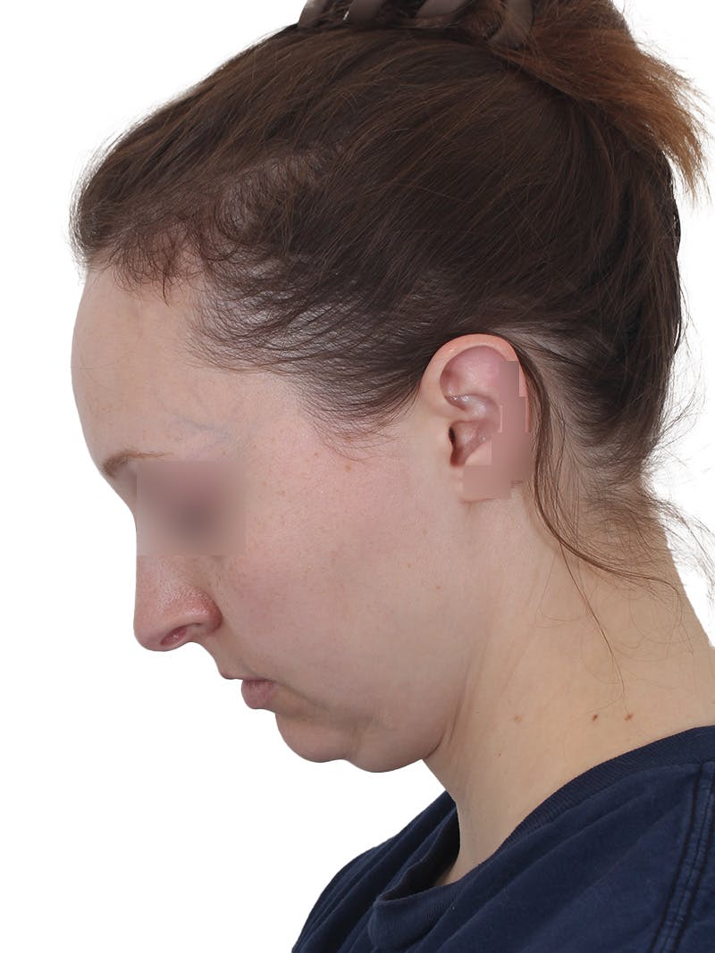 Submental Liposuction Before & After Gallery - Patient 108703 - Image 13