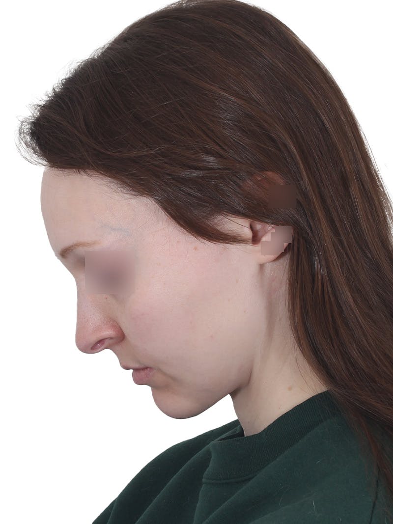 Submental Liposuction Before & After Gallery - Patient 108703 - Image 14