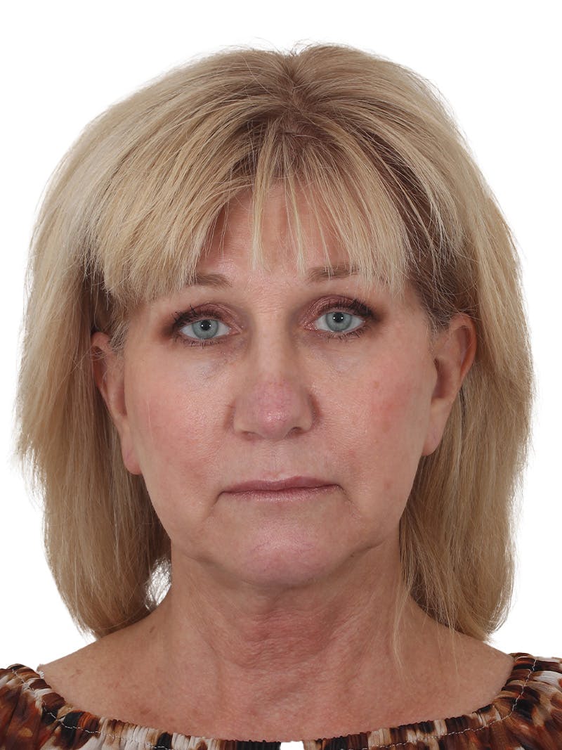 Facelift/Neck Lift Before & After Gallery - Patient 138077 - Image 1