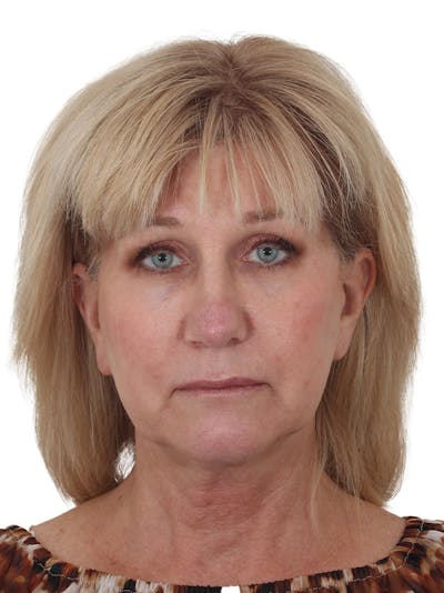 Facelift/Neck Lift Before & After Gallery - Patient 138077 - Image 1
