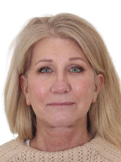 Facelift/Neck Lift Before & After Gallery - Patient 138077 - Image 2