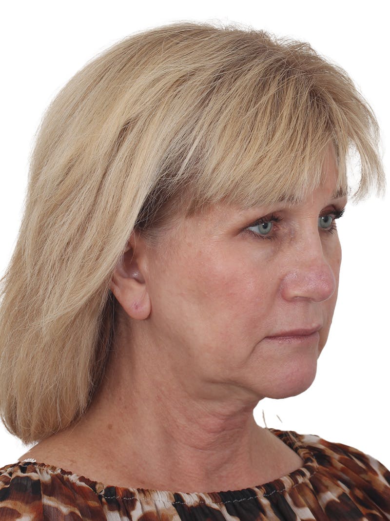 Facelift/Neck Lift Before & After Gallery - Patient 138077 - Image 3