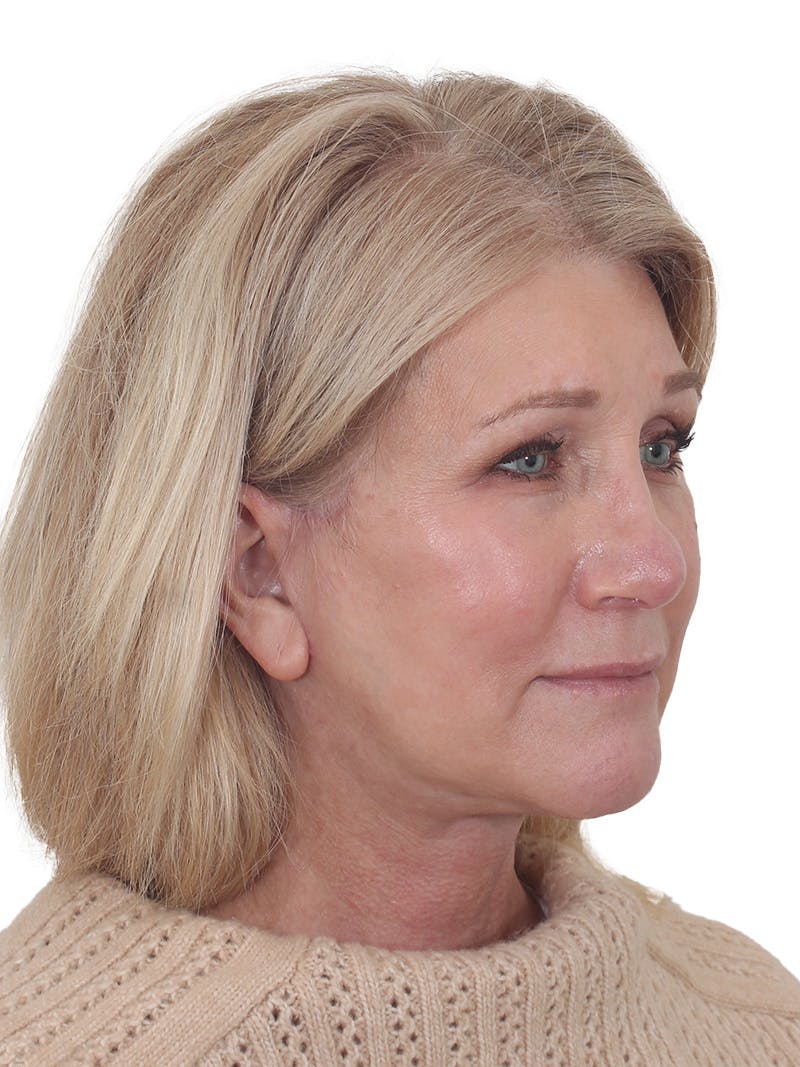 Facelift/Neck Lift Before & After Gallery - Patient 138077 - Image 4