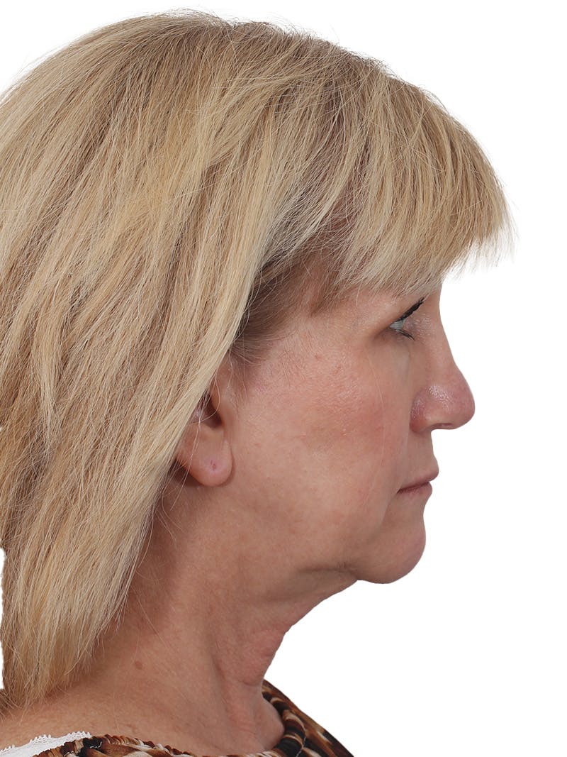 Facelift/Neck Lift Before & After Gallery - Patient 138077 - Image 5