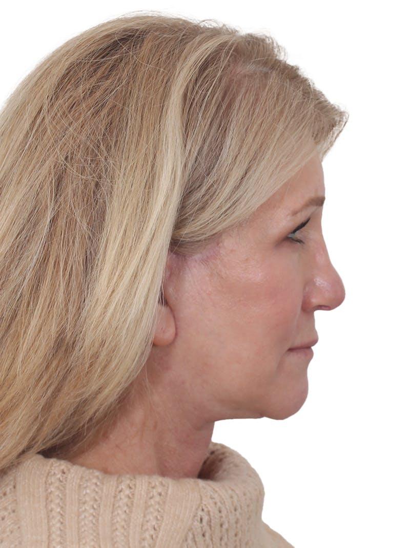 Facelift/Neck Lift Before & After Gallery - Patient 138077 - Image 6