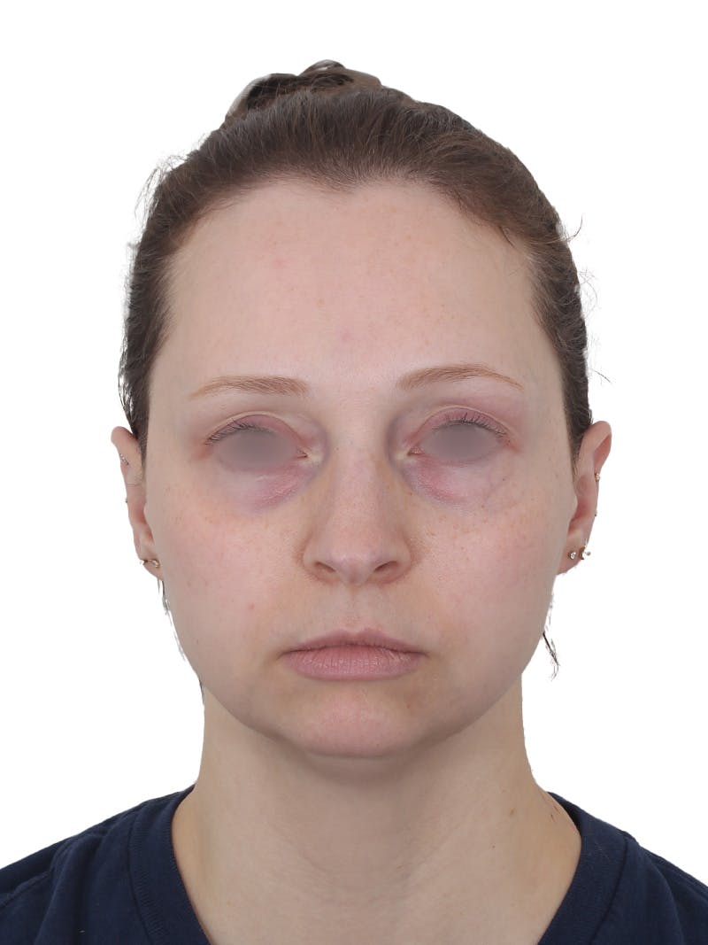 Blepharoplasty Before & After Gallery - Patient 383987 - Image 1
