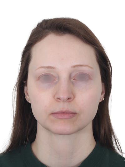 Blepharoplasty Before & After Gallery - Patient 383987 - Image 2
