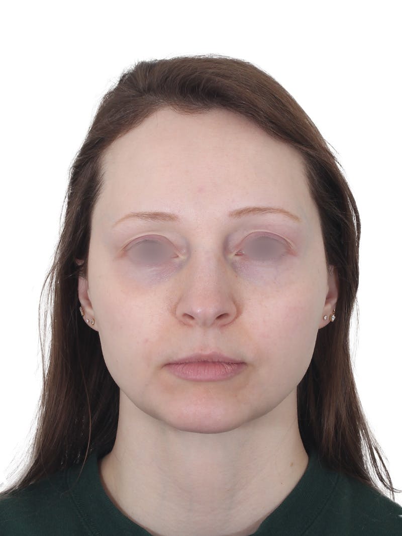 Blepharoplasty Before & After Gallery - Patient 383987 - Image 2