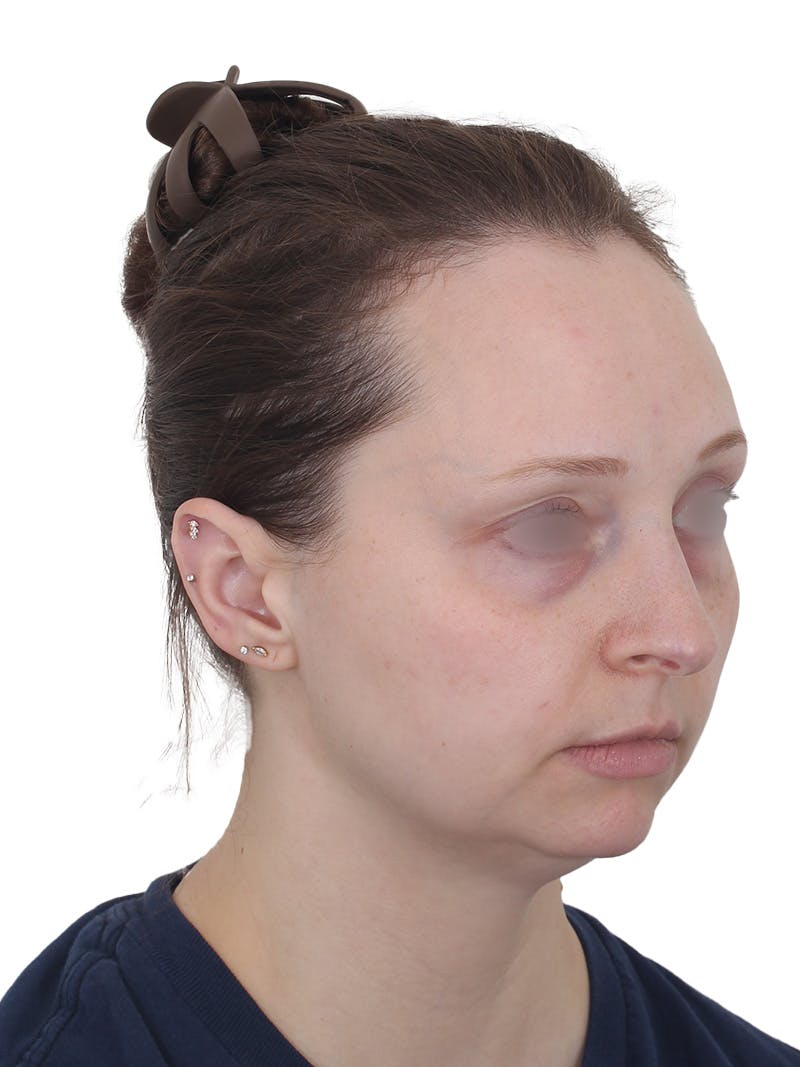 Blepharoplasty Before & After Gallery - Patient 383987 - Image 3