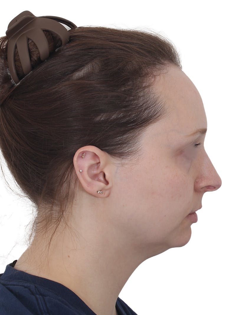 Blepharoplasty Before & After Gallery - Patient 383987 - Image 5