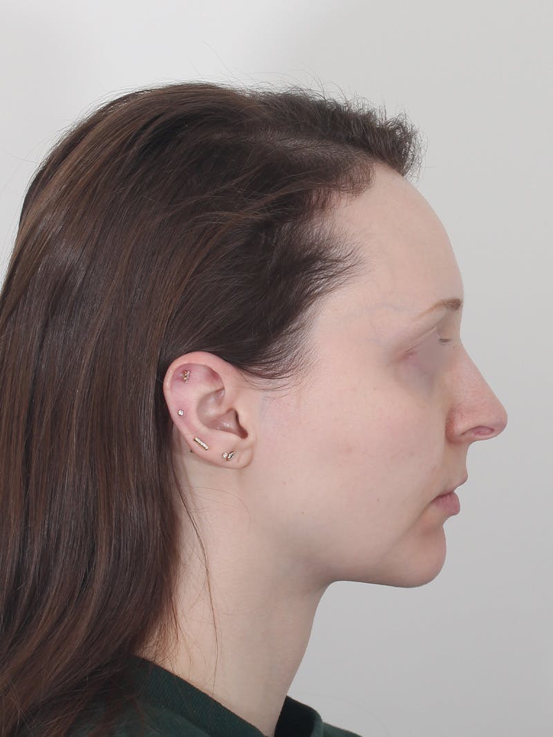 Blepharoplasty Before & After Gallery - Patient 383987 - Image 6