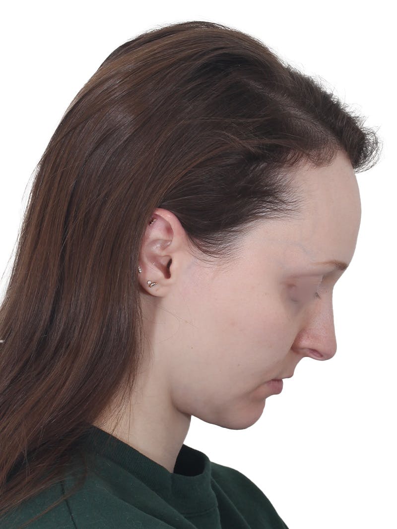 Blepharoplasty Before & After Gallery - Patient 383987 - Image 8