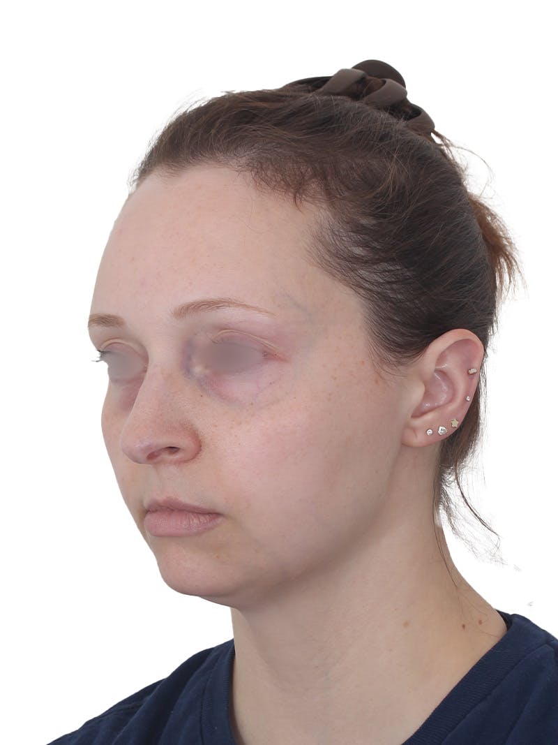 Blepharoplasty Before & After Gallery - Patient 383987 - Image 9