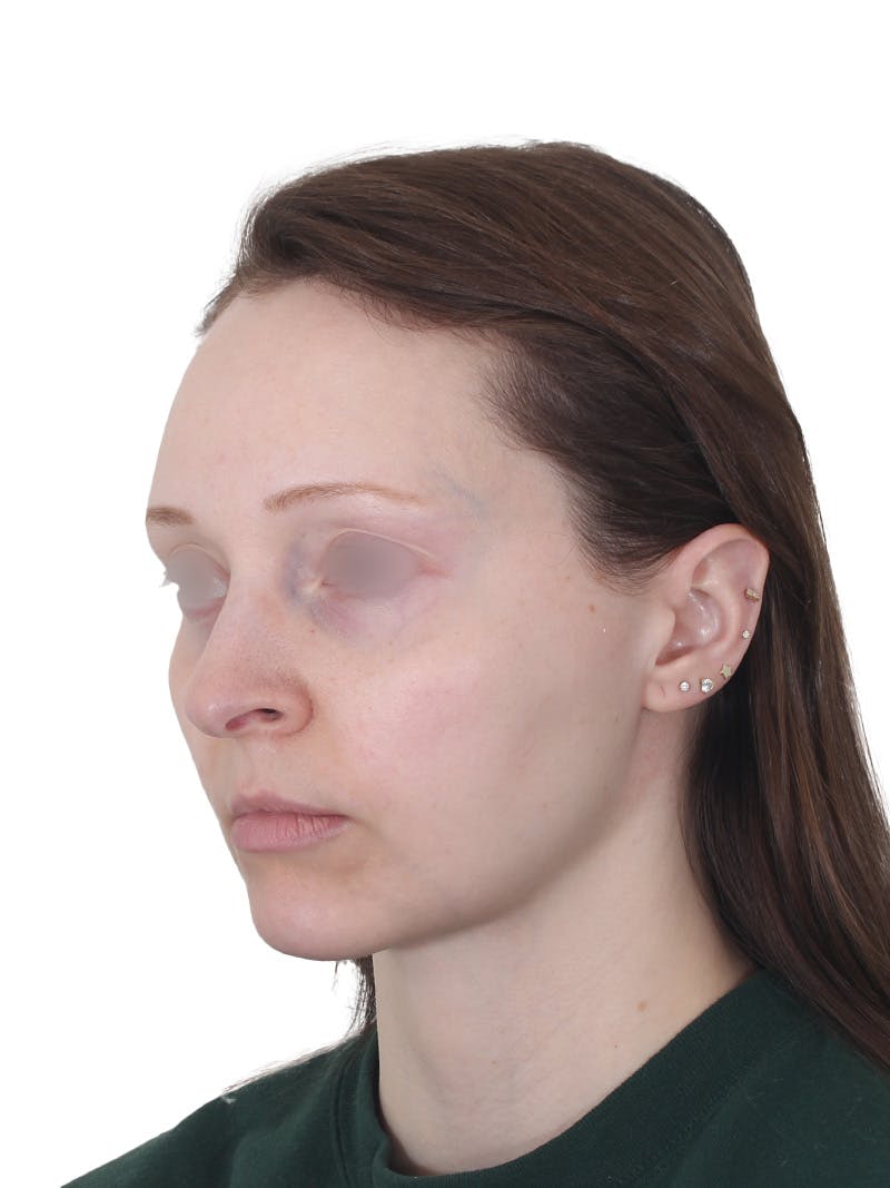Blepharoplasty Before & After Gallery - Patient 383987 - Image 10