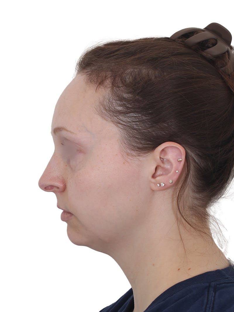 Blepharoplasty Before & After Gallery - Patient 383987 - Image 11