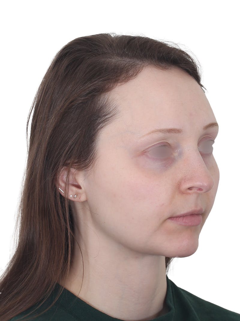 Blepharoplasty Before & After Gallery - Patient 383987 - Image 4