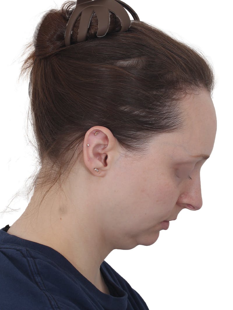 Blepharoplasty Before & After Gallery - Patient 383987 - Image 7